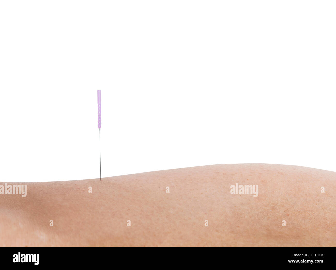 Aiguille d'Acupuncture, pincé par la peau un autre traitement. Banque D'Images