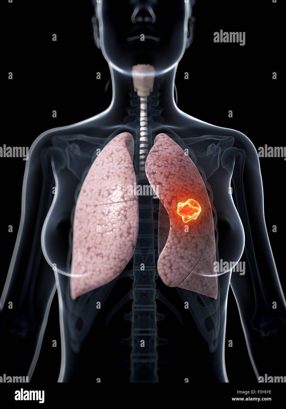 Rendu 3d illustration de cancer du poumon Banque D'Images
