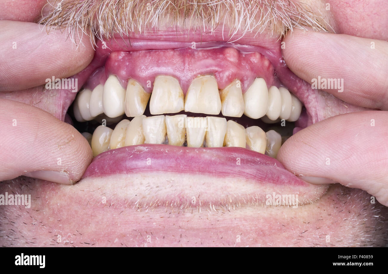 Problèmes avec les dents et les gencives Banque D'Images