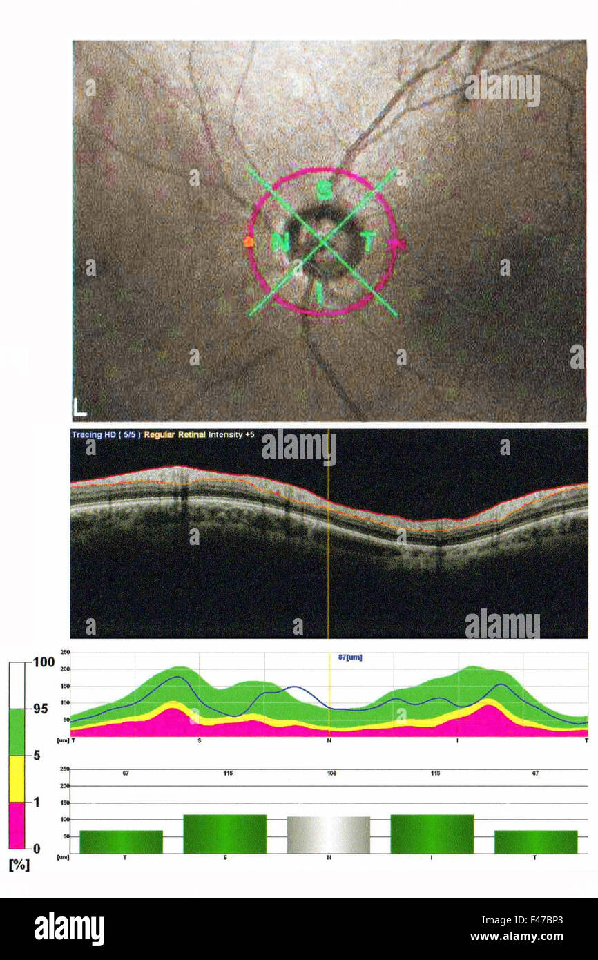 La TOMOGRAPHIE PAR COHÉRENCE OPTIQUE Banque D'Images