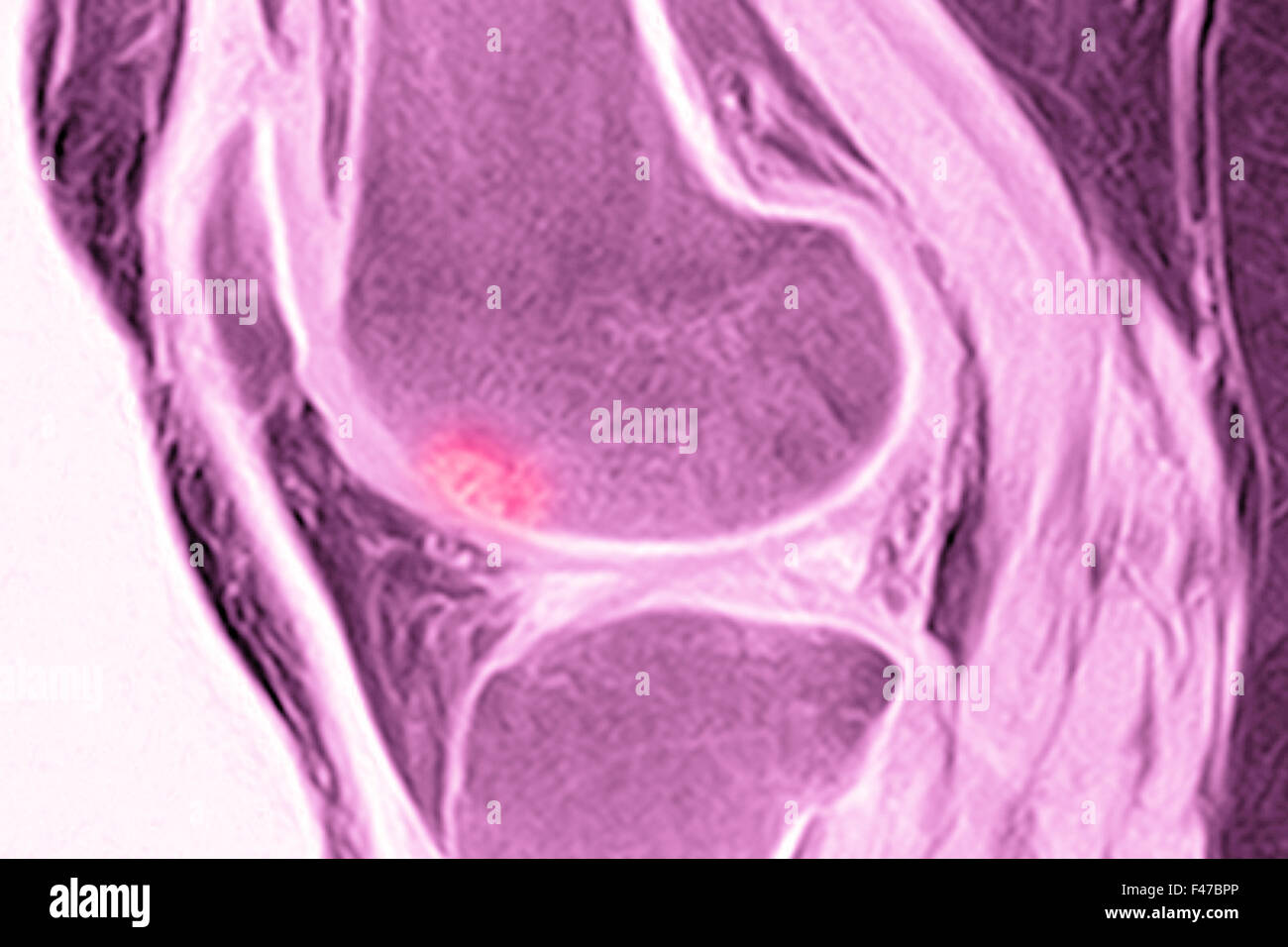 Irm ŒDÈME OSSEUX Photo Stock Alamy