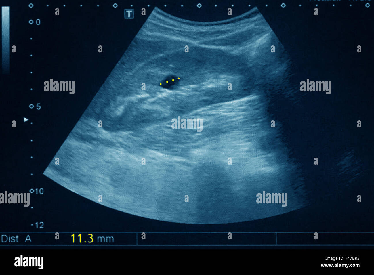 Kyste rénal, échographie Photo Stock Alamy