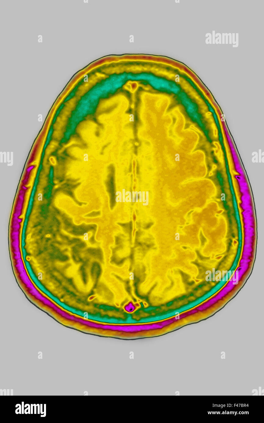 Une atrophie cérébrale, l'IRM Banque D'Images