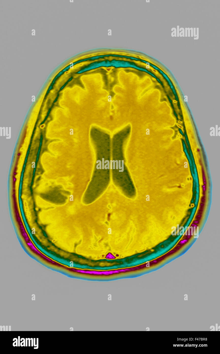 Une atrophie cérébrale, l'IRM Banque D'Images