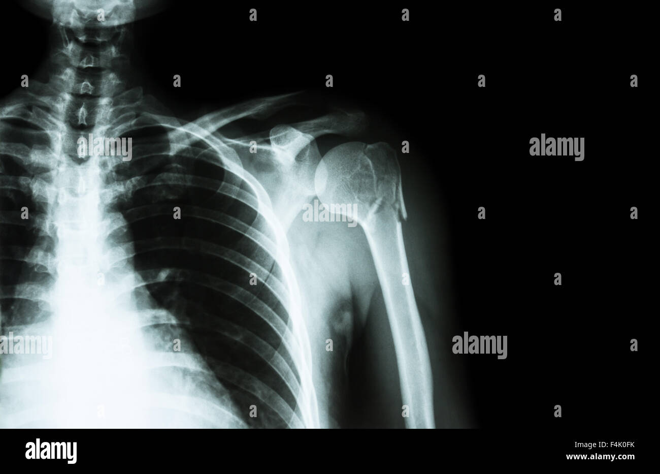 La rupture à col de l'humérus os du bras ( ) ( film x-ray à l'épaule gauche et la zone vide du côté droit ) Banque D'Images