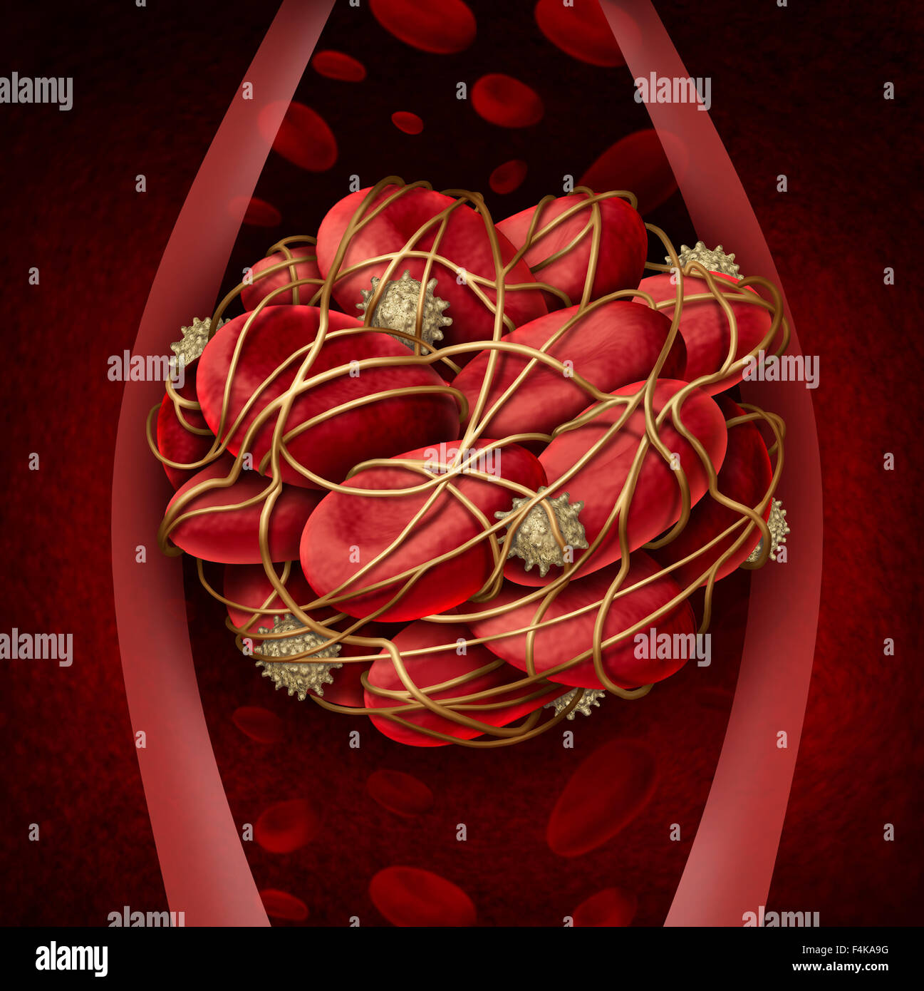 Caillot de sang et de thrombose concept illustration médicale comme un groupe de cellules sanguines humaines regroupés ensemble par des plaquettes collantes et Banque D'Images