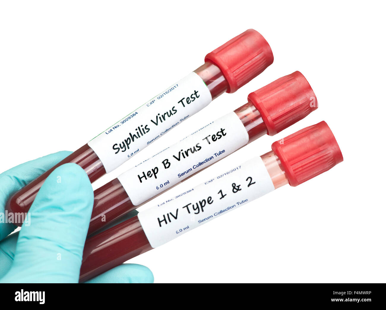 La syphilis, VIH, hépatite B et des tubes de prélèvement d'un échantillon  de sang tenue par technicien Photo Stock - Alamy