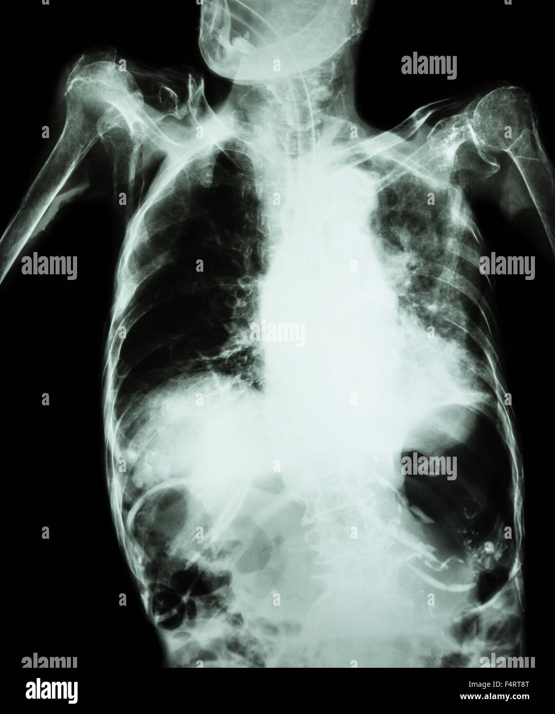 La tuberculose pulmonaire avec insuffisance respiratoire aiguë ( Film radiographie pulmonaire de l'ancien show patient interstitielle et alvéolaire infiltrat Banque D'Images