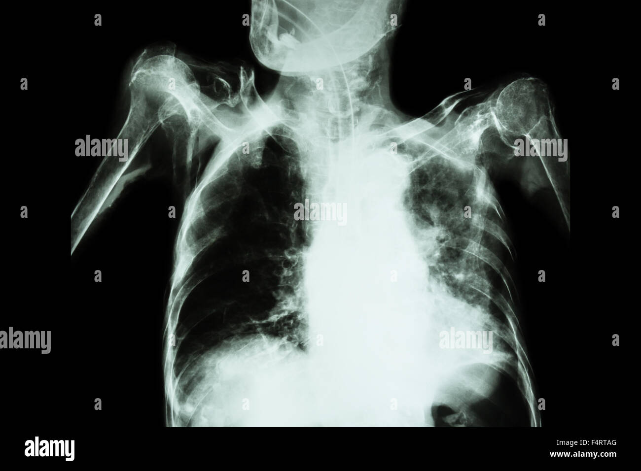 La tuberculose pulmonaire avec insuffisance respiratoire aiguë ( Film radiographie pulmonaire de l'ancien show patient interstitielle et alvéolaire infiltrat Banque D'Images