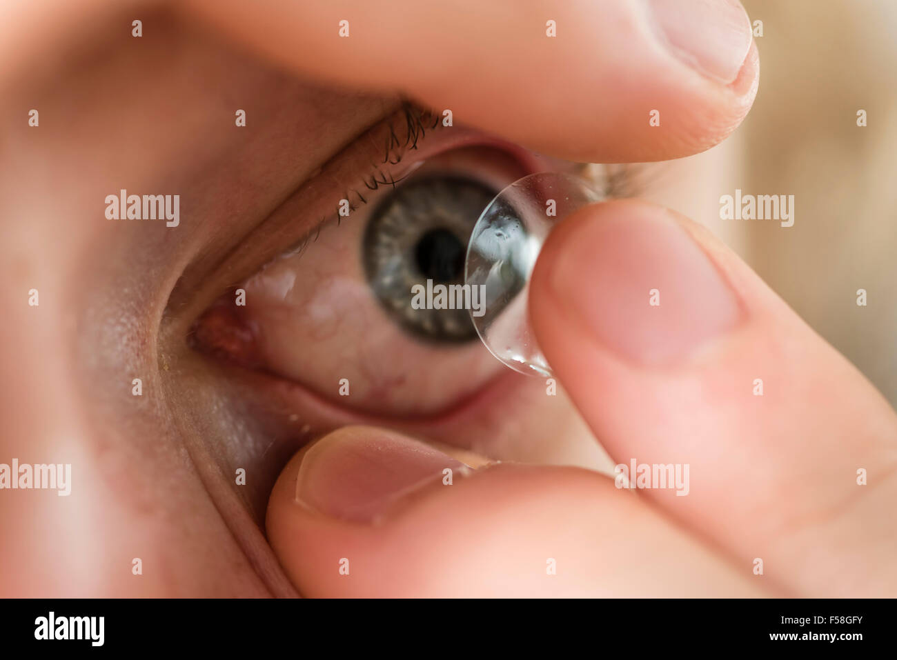 Un homme est l'insertion d'une lentille de contact sur l'œil gauche. Banque D'Images