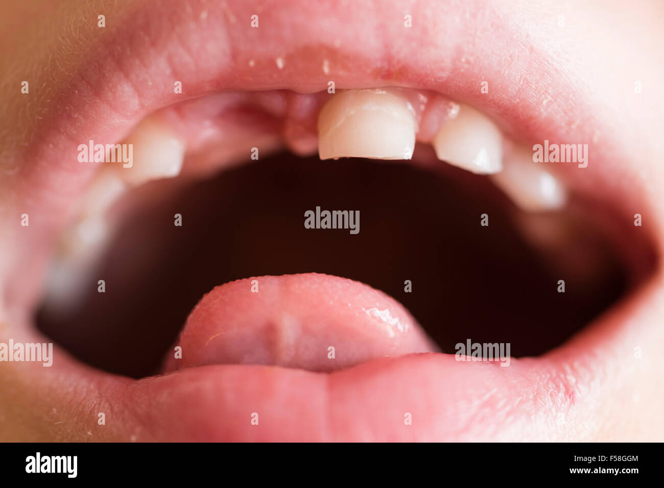 L'écart de la dentition primaire crantée d'un garçon de 7 ans Banque D'Images