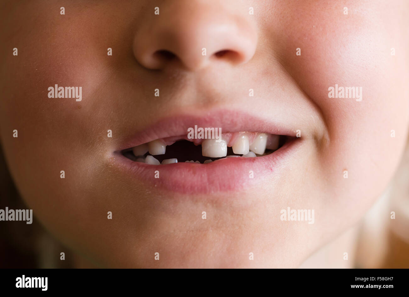 L'écart de la dentition primaire crantée d'un garçon de 7 ans Banque D'Images