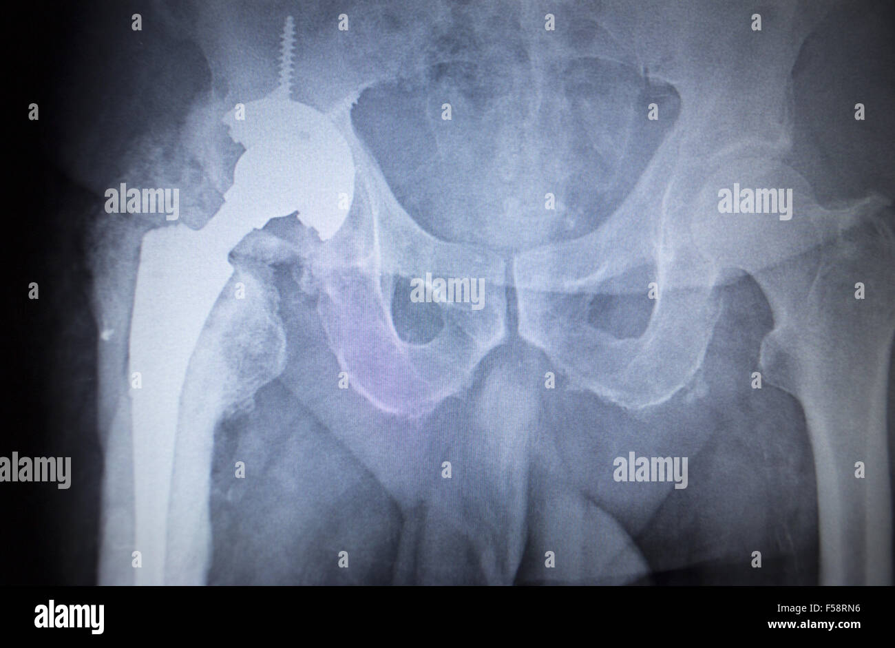 X-ray image scan de joints de hanche squelette humain en bleu gris. Numérisé en orthopédie traumatologie Hôpital clinique de chirurgie. Banque D'Images
