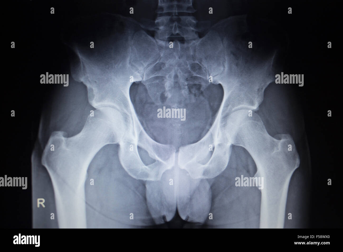 X-ray image scan de joints de hanche squelette humain en bleu gris. Numérisé en orthopédie traumatologie Hôpital clinique de chirurgie. Banque D'Images