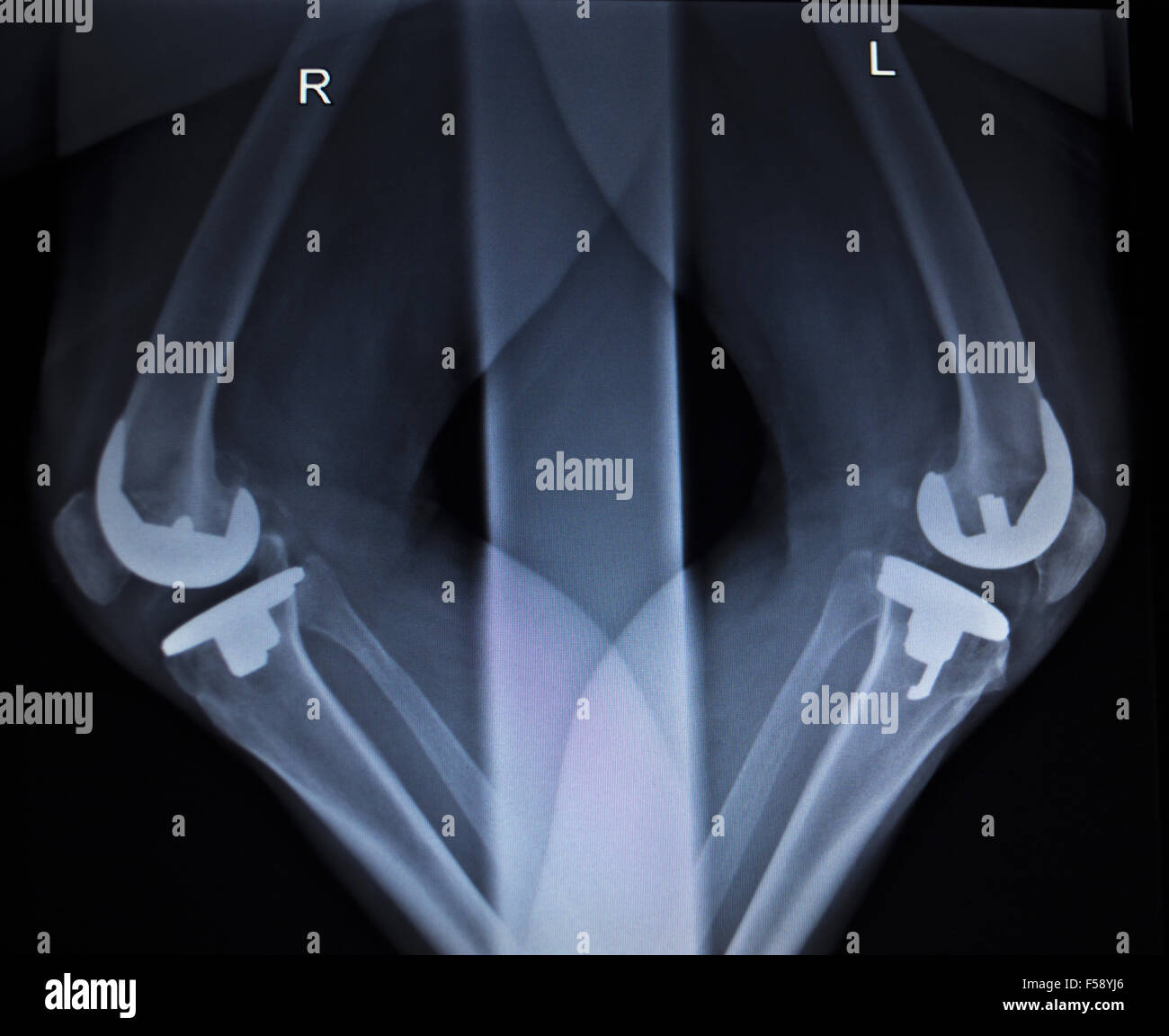 Xray scanner médical orthopédique de ménisque du genou jambe douloureuse blessure en