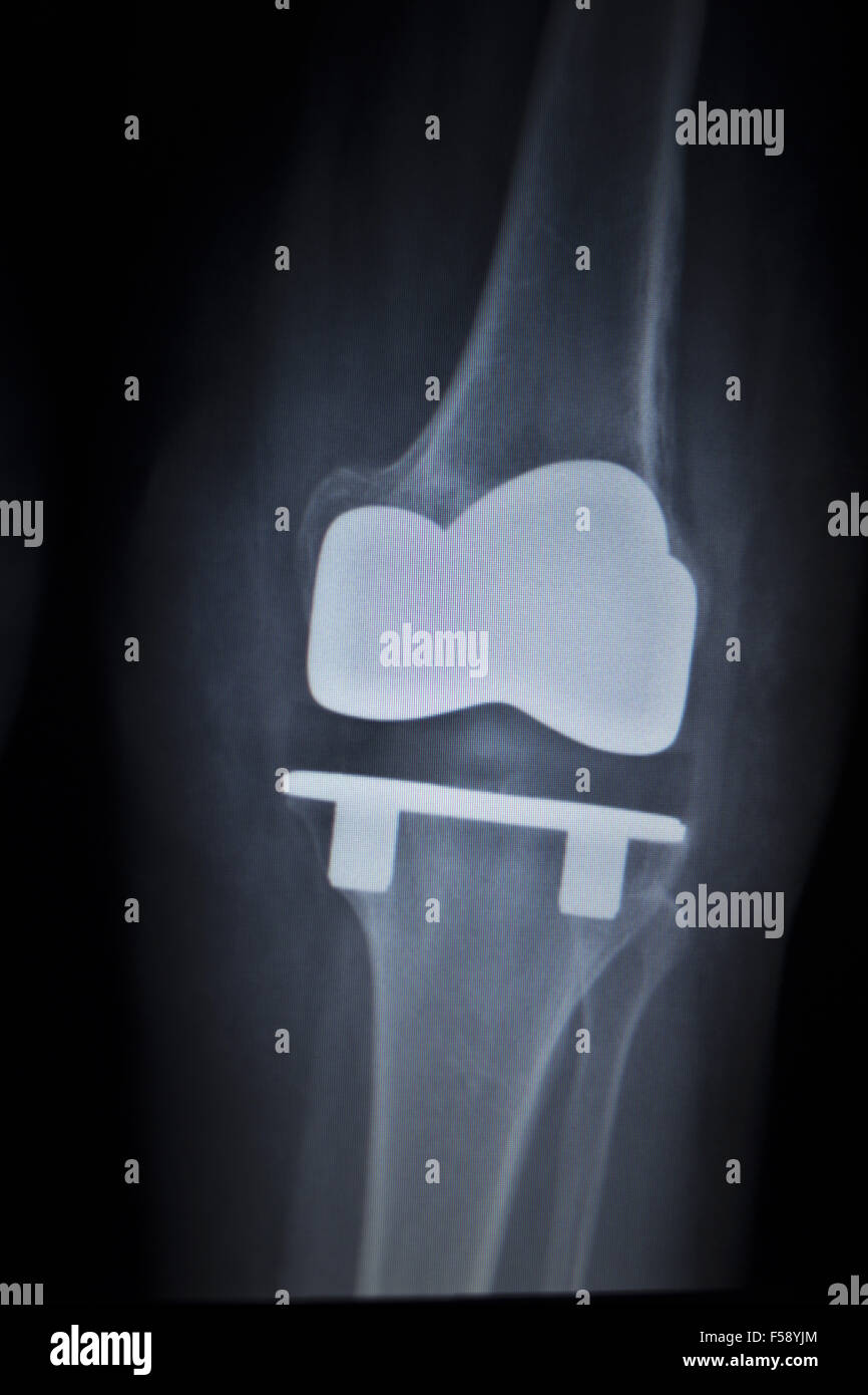 Xray scanner médical orthopédique de ménisque du genou jambe douloureuse blessure en