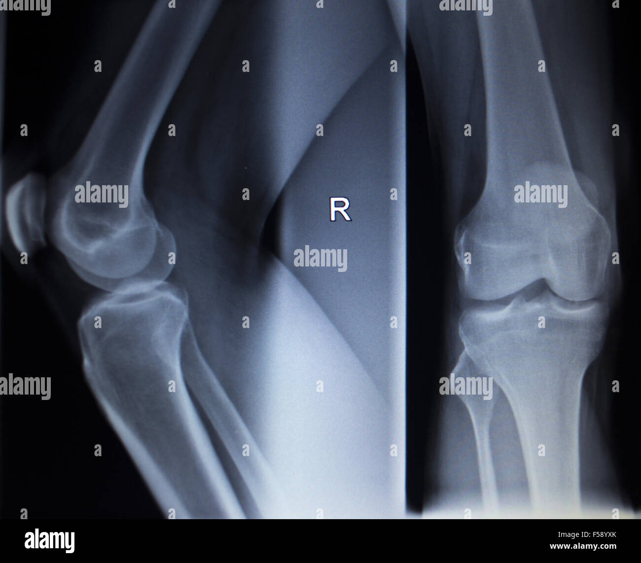 Xray scanner médical orthopédique de ménisque du genou jambe douloureuse blessure en