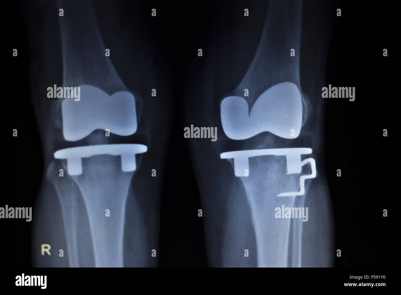 Xray scanner médical orthopédique de ménisque du genou jambe douloureuse blessure en