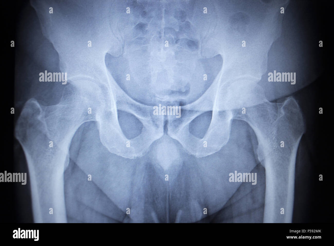 X-ray image scan de joints de hanche squelette humain en bleu gris. Numérisé en orthopédie traumatologie Hôpital clinique de chirurgie. Banque D'Images