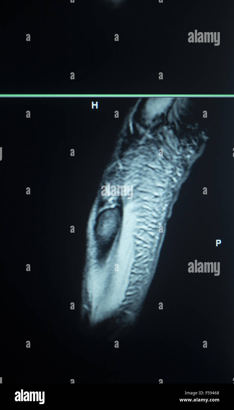 L'imagerie par résonance magentic MRI scan balayage nucléaire résultats test pied orteils photo blessures. Banque D'Images