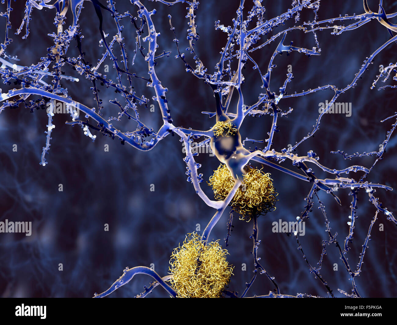 La maladie d'Alzheimer. Illustration d'ordinateur de plaques amyloïdes entre les neurones. Les plaques amyloïdes sont caractéristiques de Banque D'Images