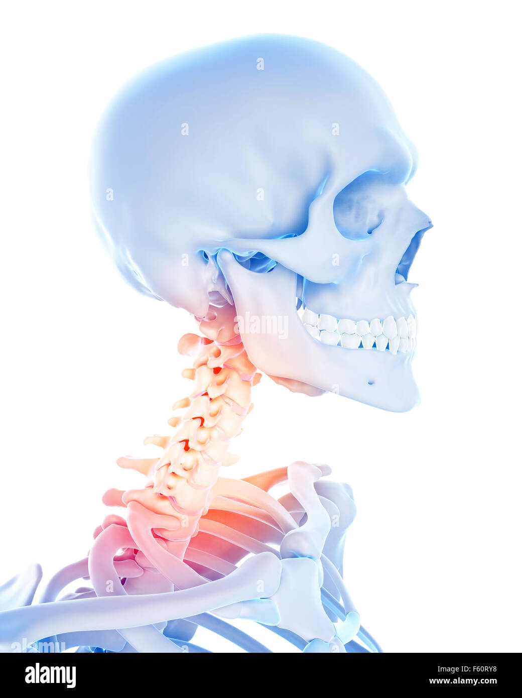 Medical 3d illustration d'un rachis cervical douloureux Banque D'Images