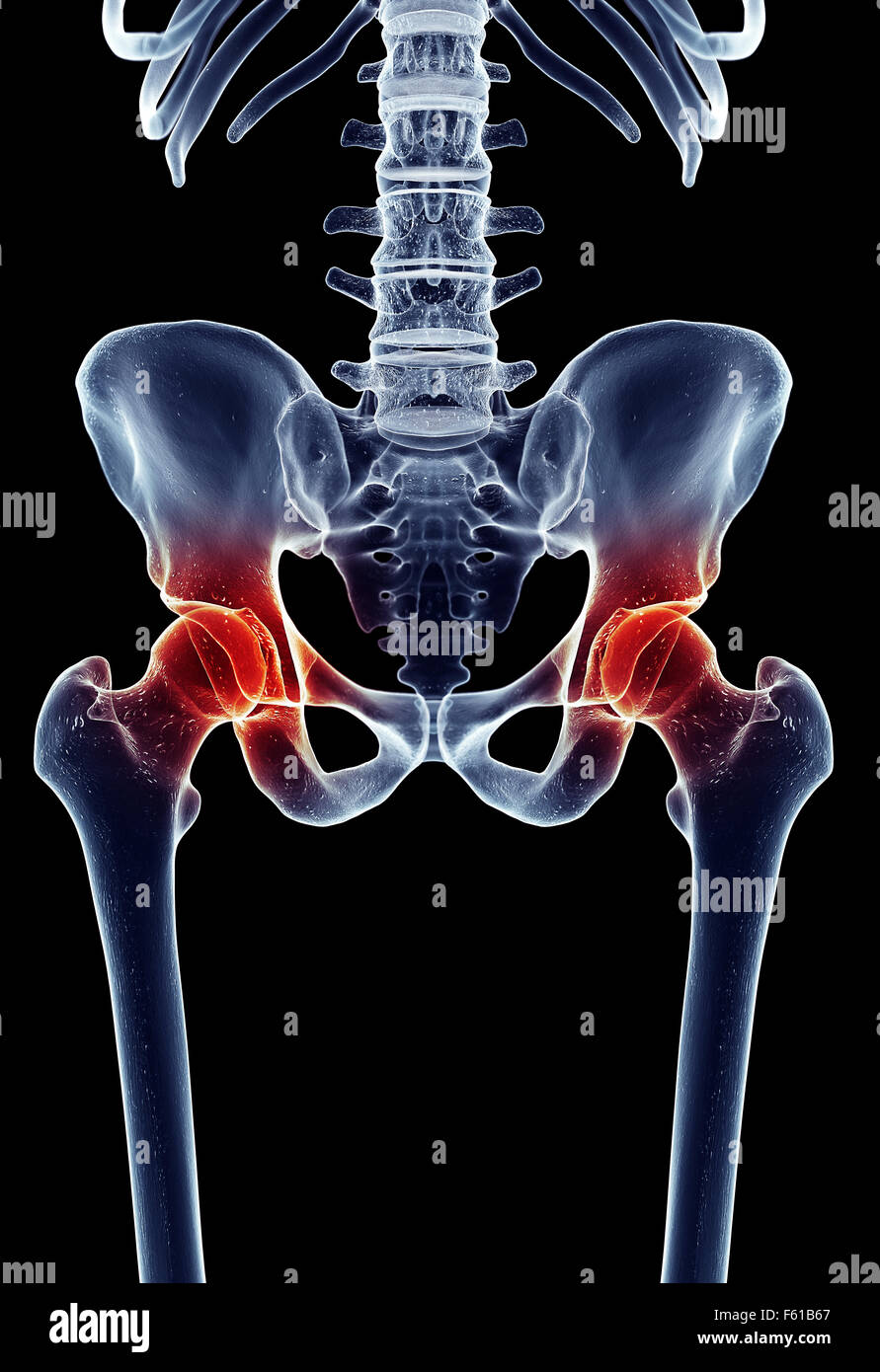 Illustration - médicalement exacts de la hanche douloureuse Banque D'Images