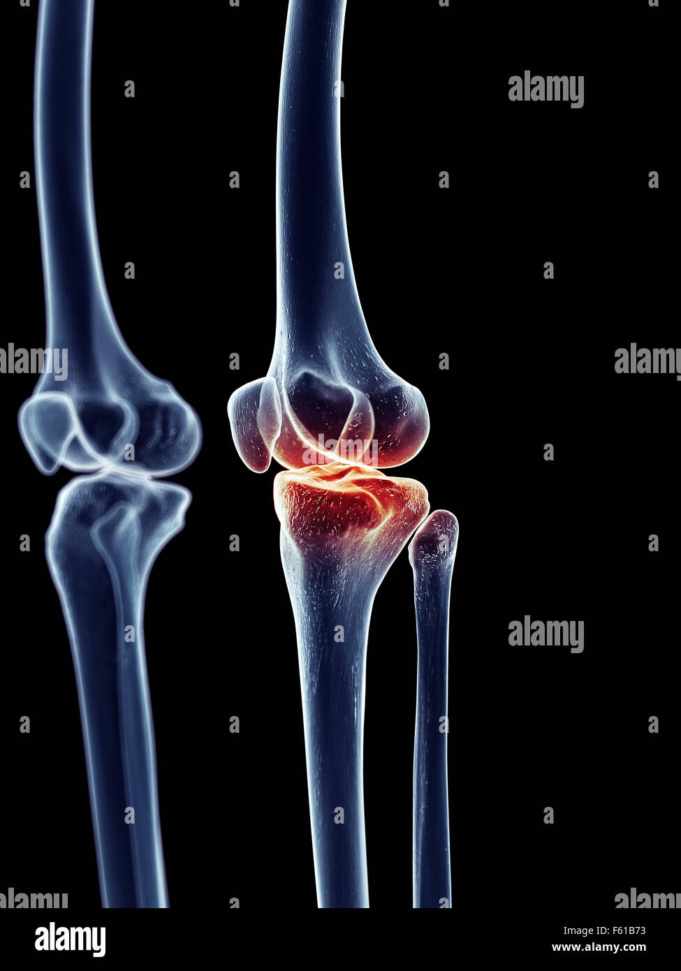 L'arthrose du genou l'anatomie des os du squelette de la jambe Photo ...