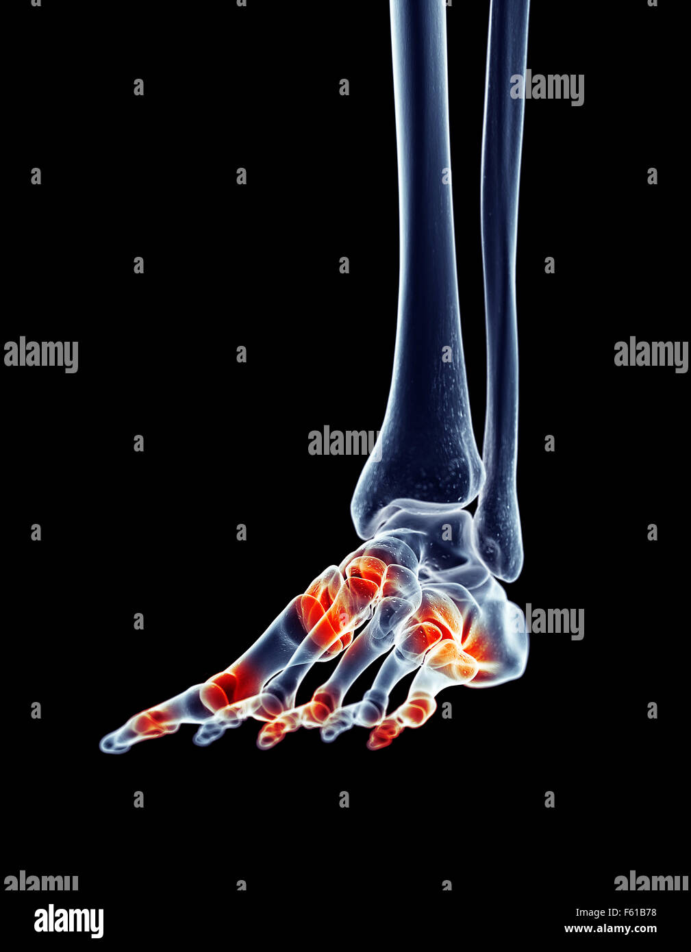 Illustration - médicalement exacts des articulations du pied douloureux Banque D'Images