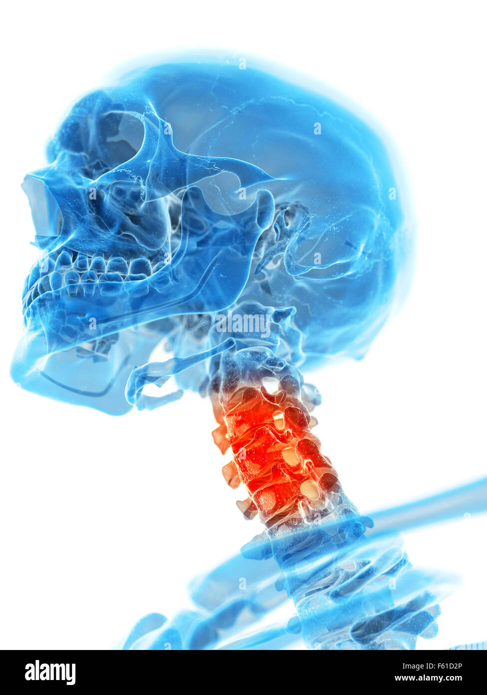 Illustration - médicalement exacts du rachis cervical douloureux Banque D'Images