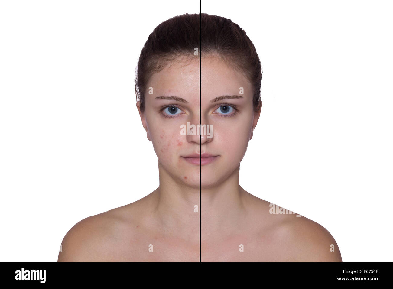 Portrait d'une belle jeune fille avec des taches sur la moitié de la face, l'autre moitié du visage est lisse isolé sur un blanc retour Banque D'Images