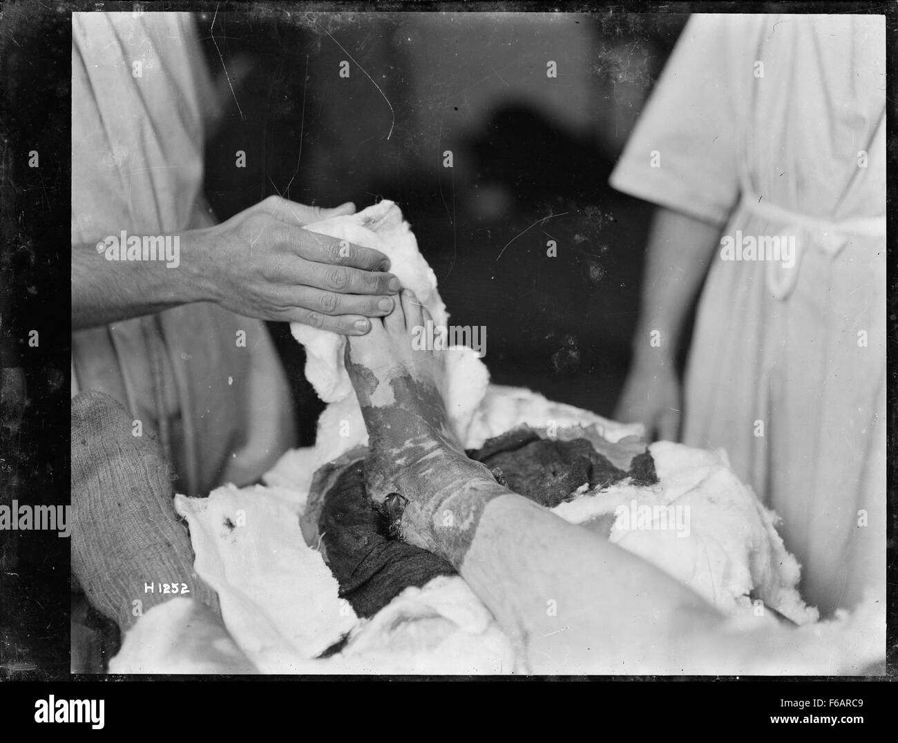 Cette image représente un soldat qui a subi une blessure à la cheville par balle pendant la première Guerre mondiale, montrant le bilan physique du conflit sur les soldats au début du XXe siècle. Banque D'Images