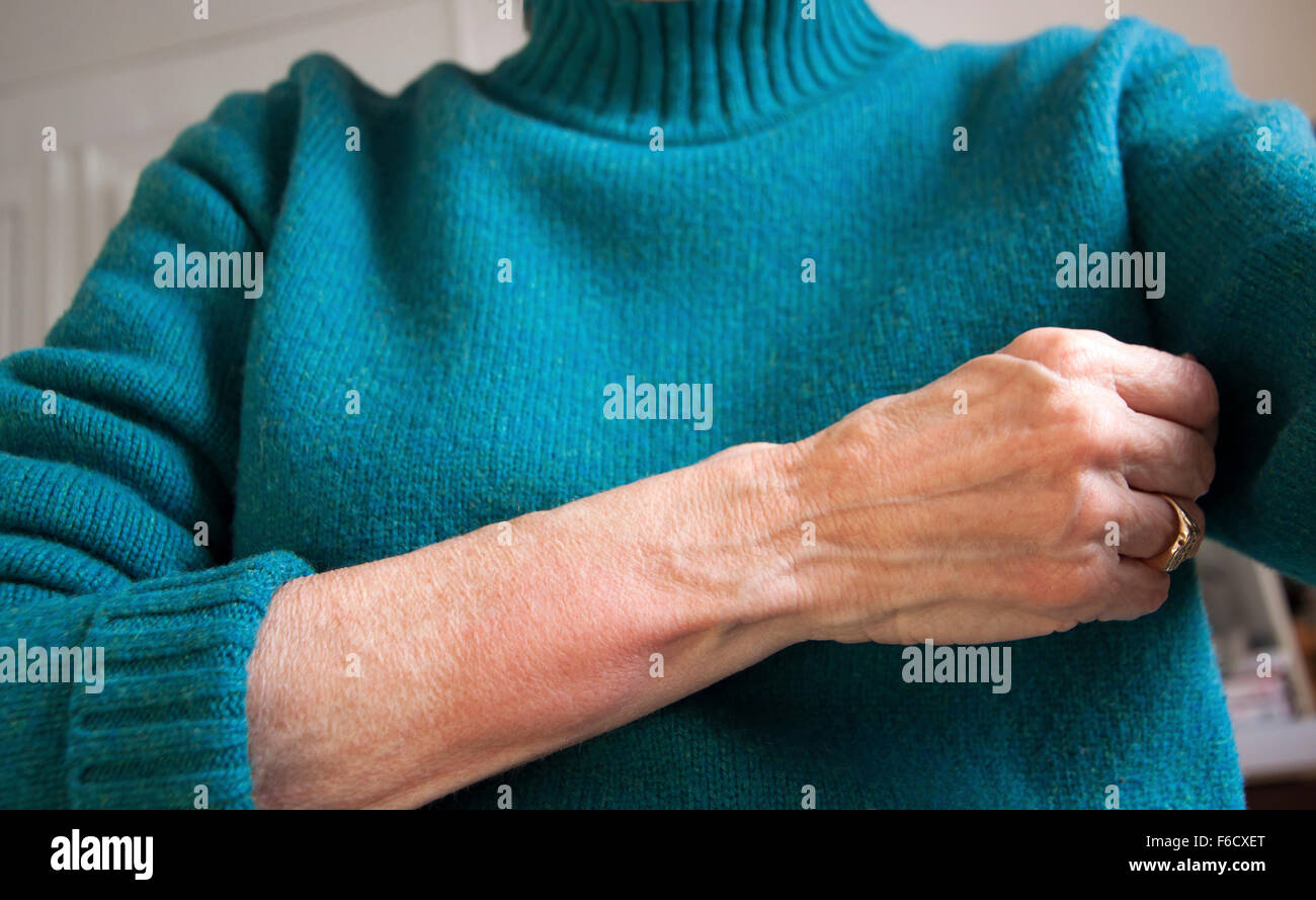 Swelling arm Banque de photographies et d'images à haute résolution - Alamy