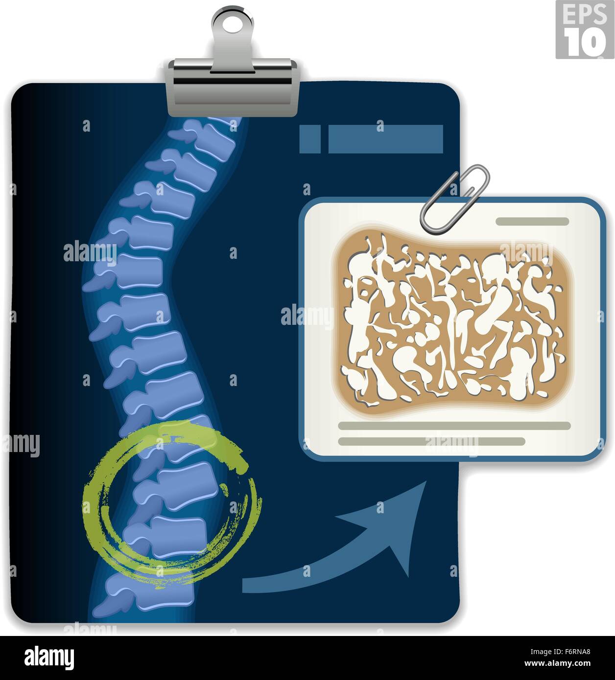 X-ray montrant l'ostéoporose dans la colonne vertébrale, les résultats avec la structure de l'os fragile. Illustration de Vecteur