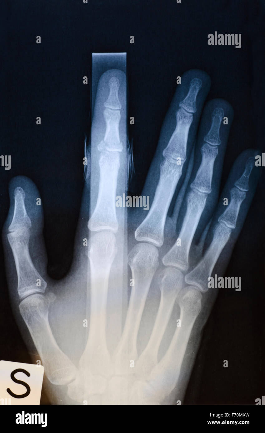 X-ray image de main humaine avec stick de fractures Banque D'Images