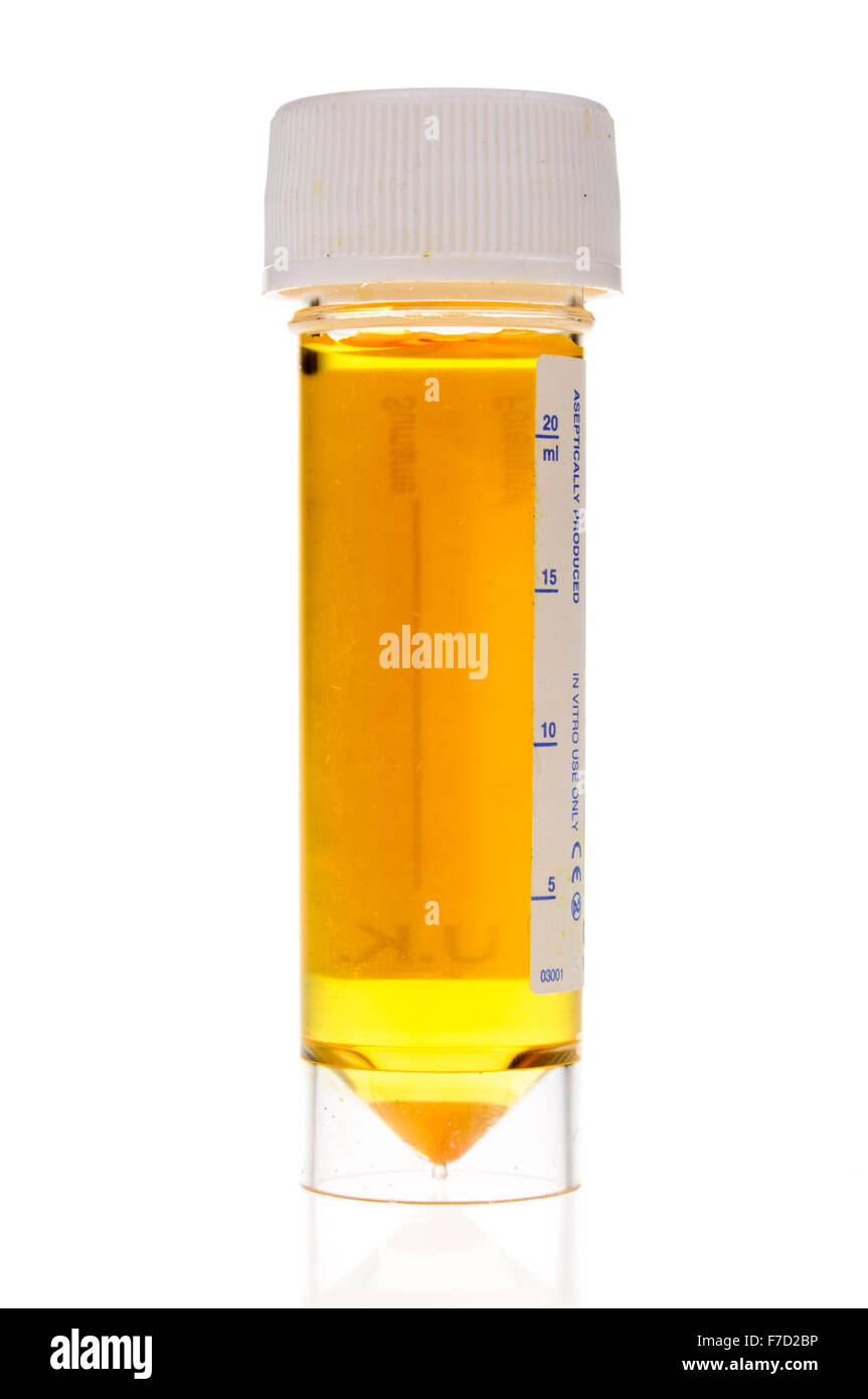 Urine foncée dans un flacon d'échantillonnage en plastique transparent Photo