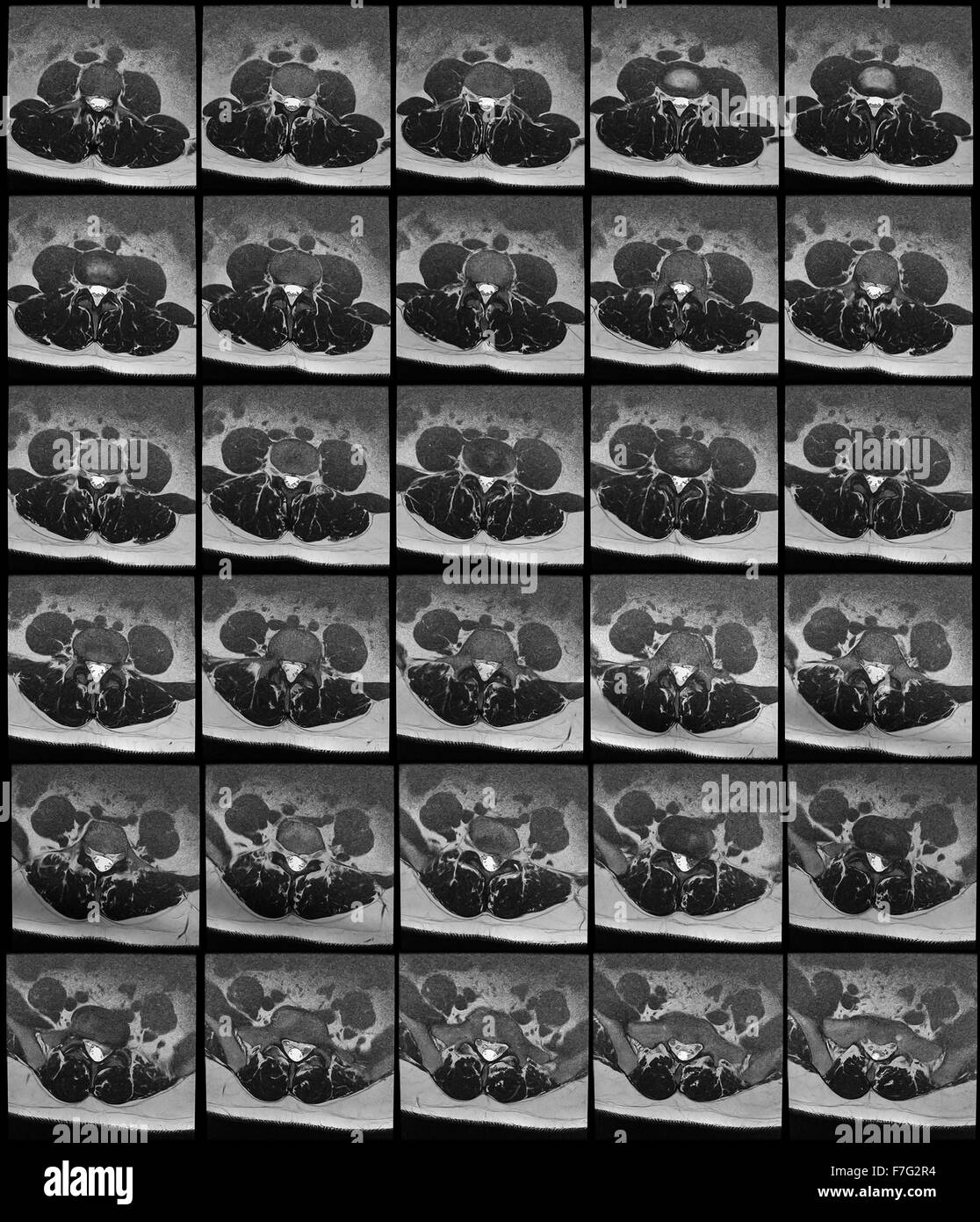 L'IRM de l'abdomen et la colonne vertébrale des organes Section Rachis Banque D'Images
