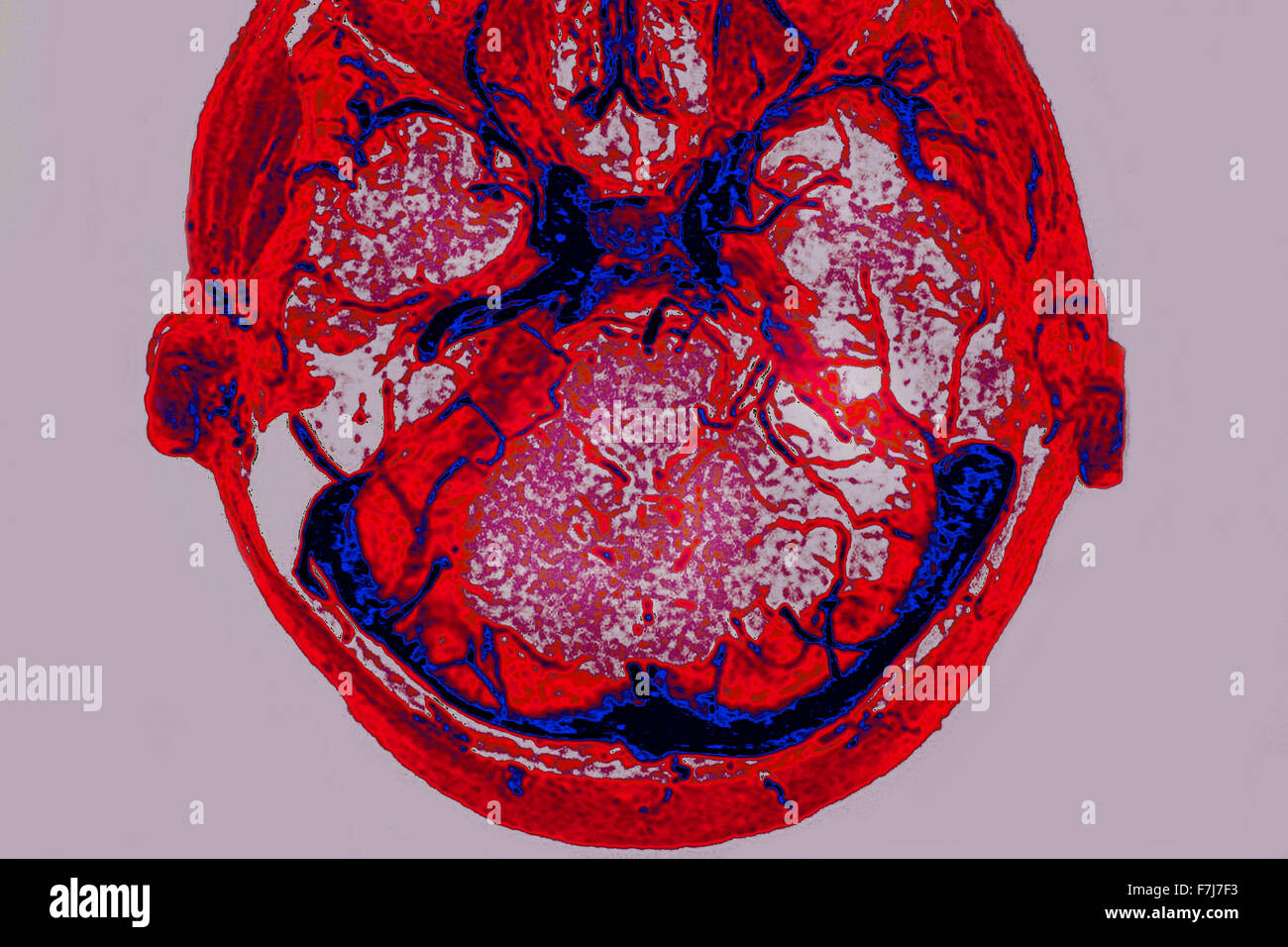 Thrombose veineuse cérébrale Banque D'Images