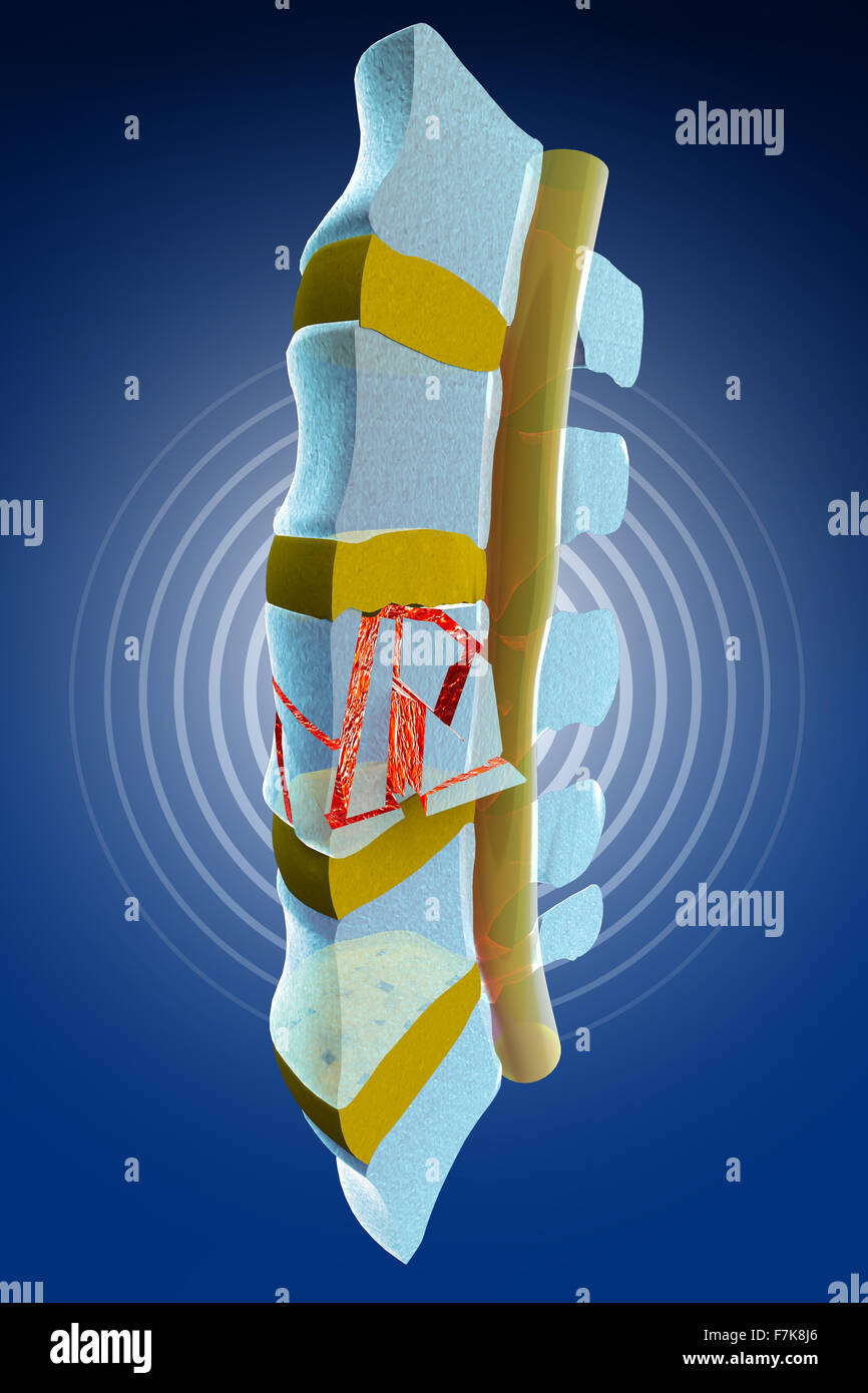 Colonne vertébrale, moelle osseuse, les fractures vertébrales traumatiques, burst fracture. La section de la colonne vertébrale Banque D'Images