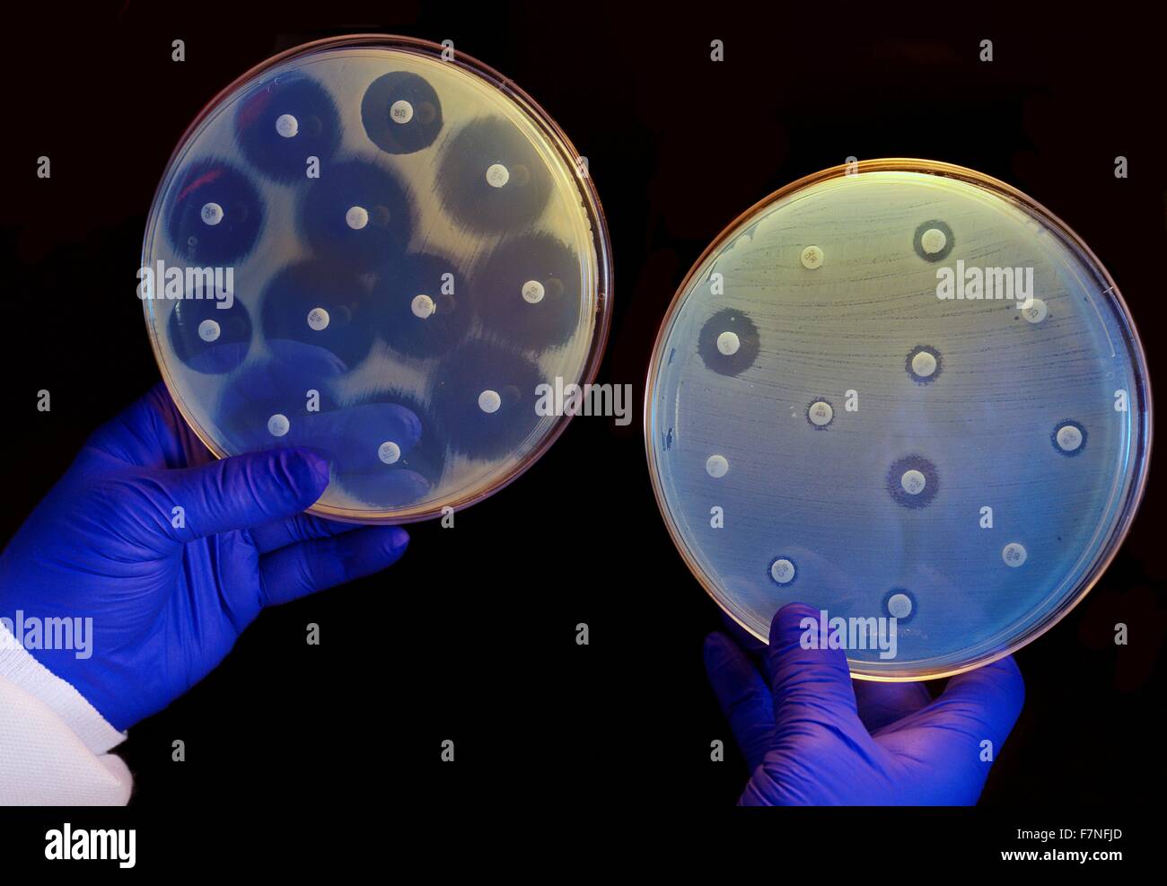 Deux plaques des bactéries en présence de disques contenant des divers antibiotiques. L'isoler sur la plaquette gauche est sensible aux antibiotiques sur les disques et n'est pas en mesure de se développer autour des disques. L'un sur la droite a un CRE qui est résistant à tous les antibiotiques testés et est en mesure de croître près du disques. Banque D'Images