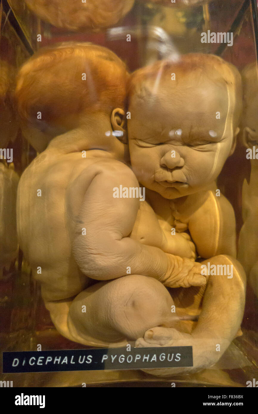 Conjoined Twins du cou aux bassin conservés dans du formol jar. Medical Museion à Copenhague. Banque D'Images