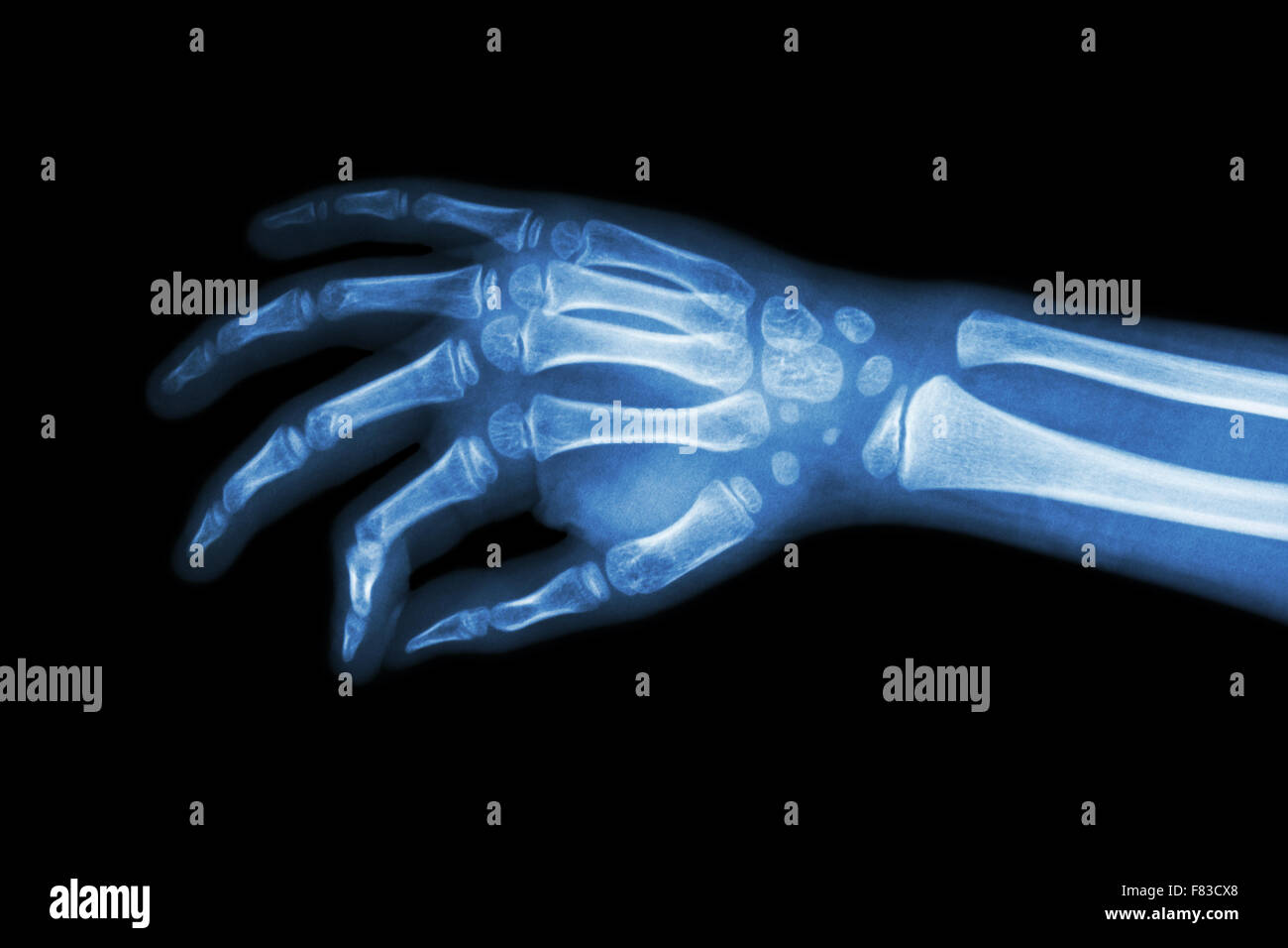 Film x-ray main de l'enfant ( vue oblique ) Banque D'Images