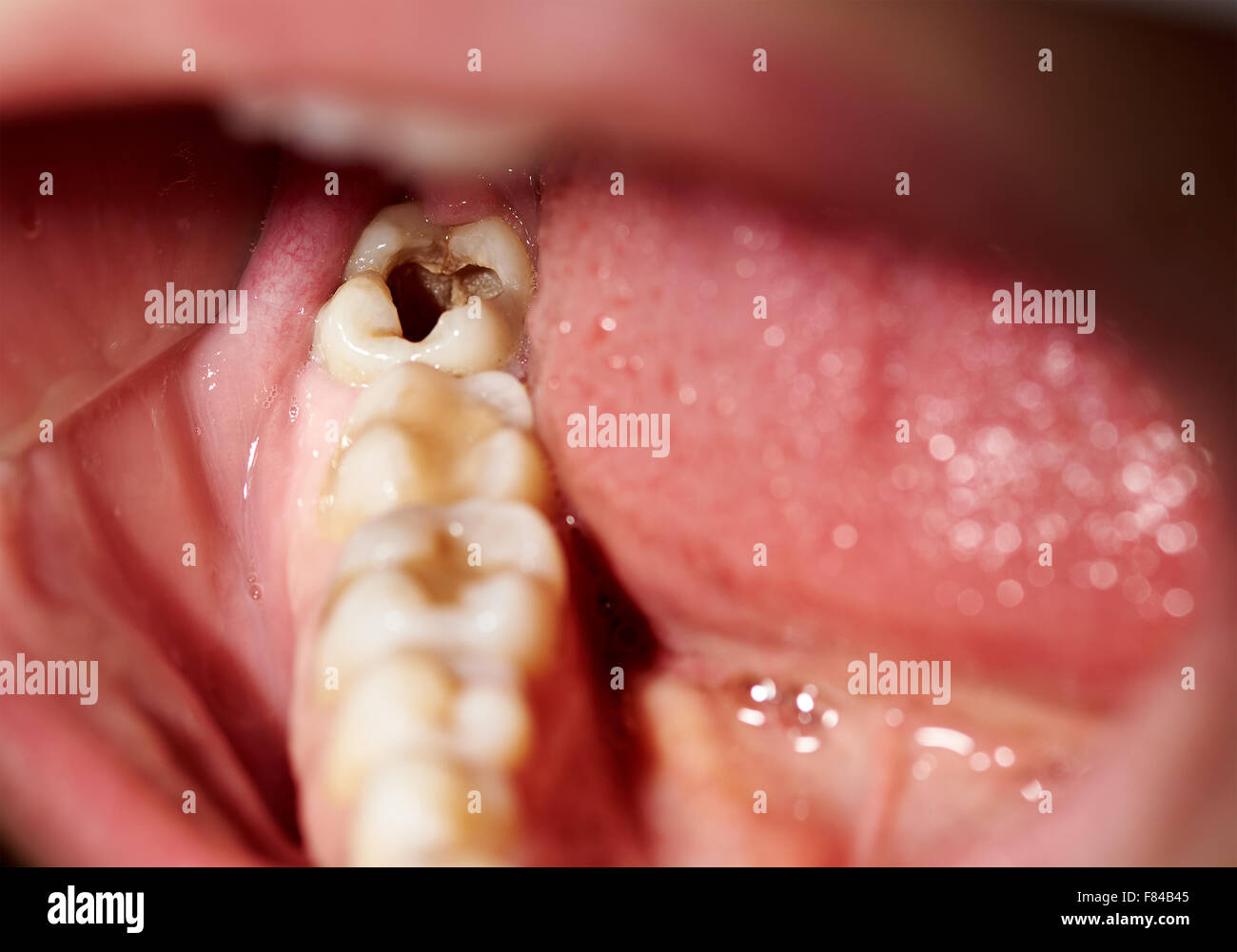 Modèle De Préparation Dentaire En Résine - Pour Pratique Des Caries Et Obturations, étudiants Dentistes