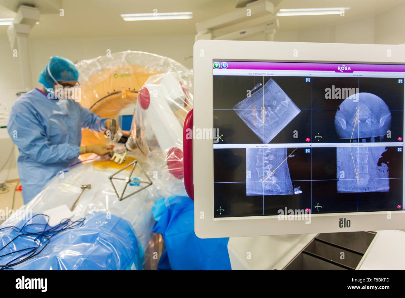 Patient recevant une prothèse de disque intervertébral pour traiter les hernies discales avec Rosa dos ® robot, l'hôpital d'Amiens, France. Banque D'Images