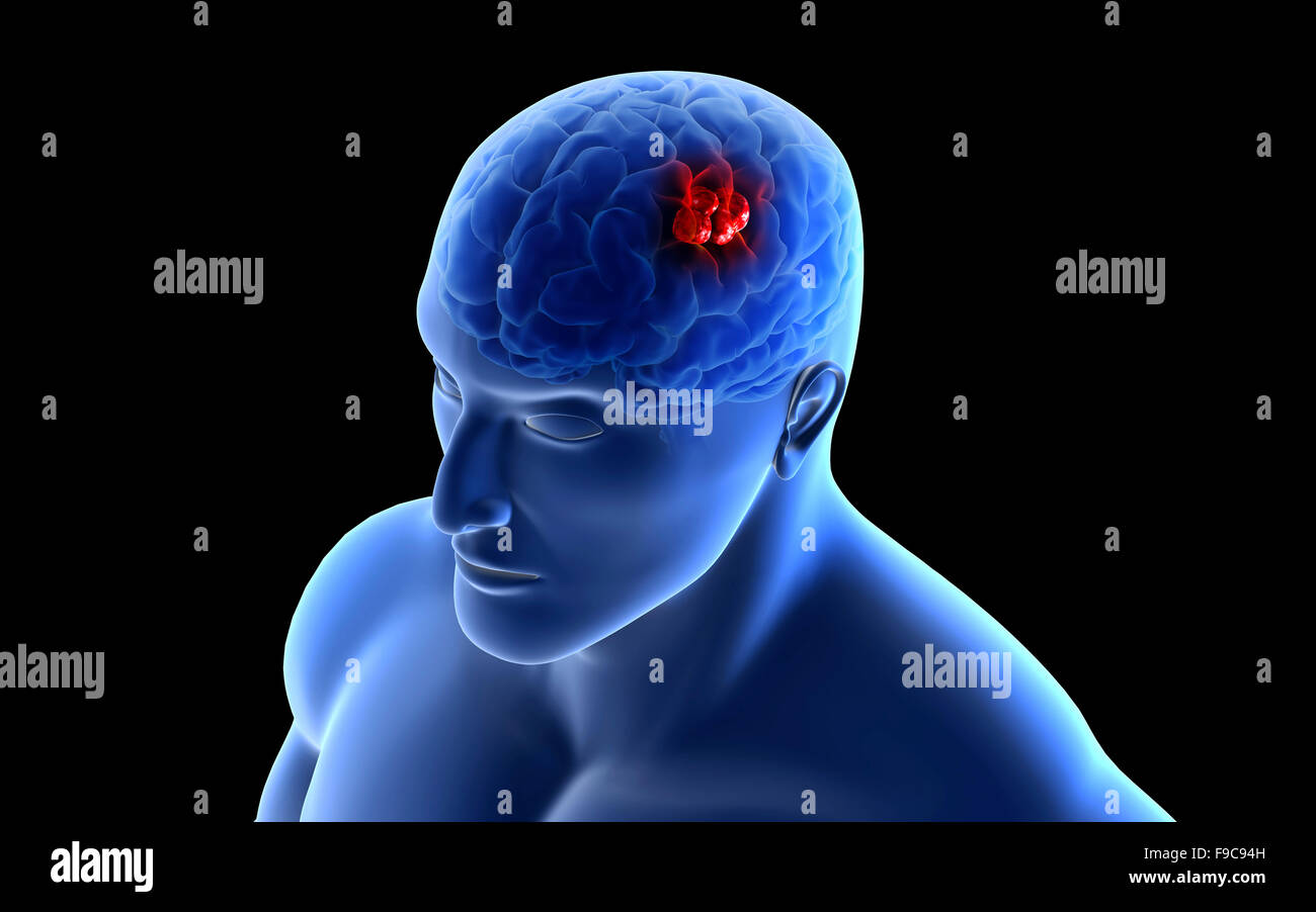 Image conceptuelle d'une tumeur au cerveau humain. Banque D'Images
