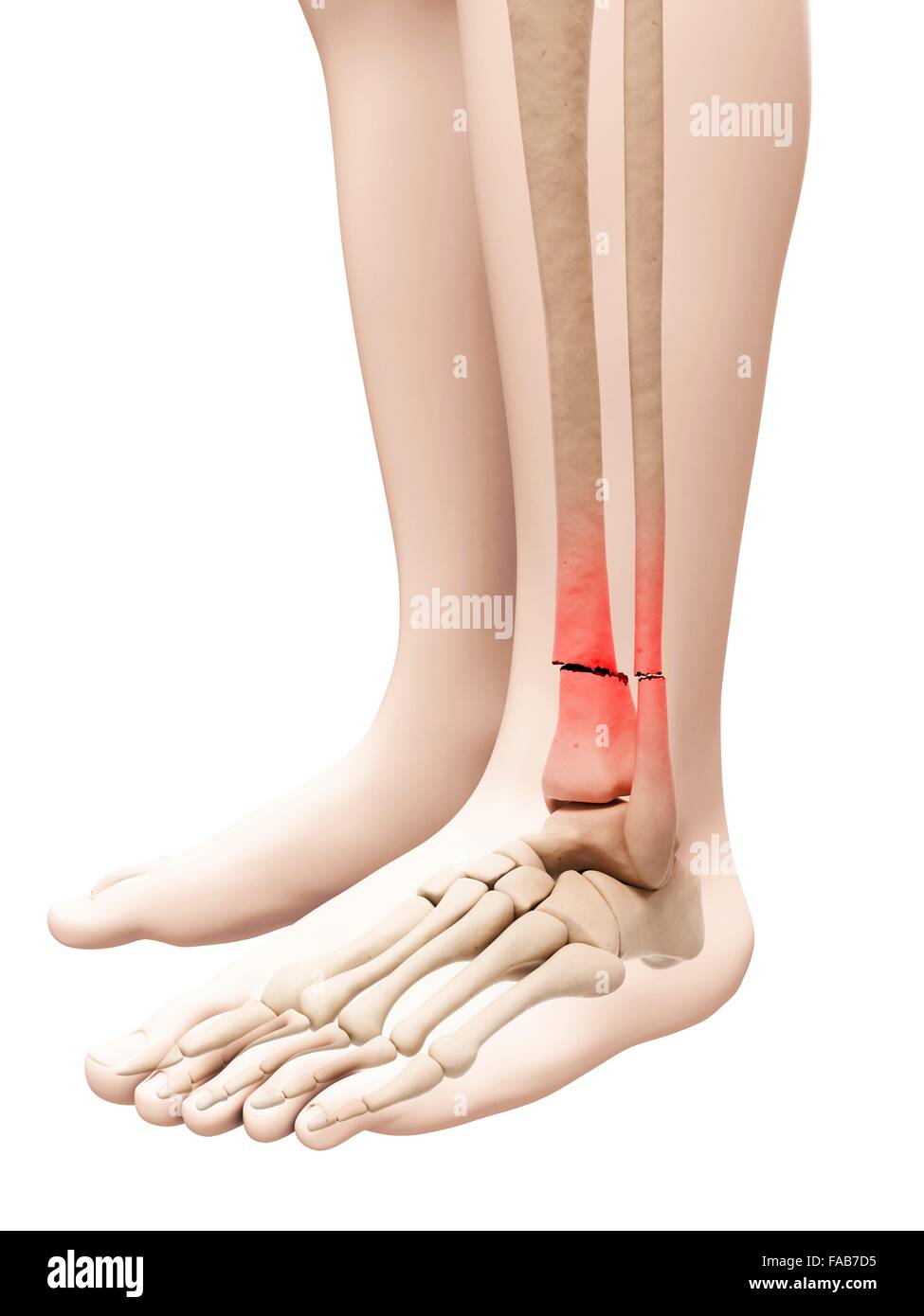 Les os de la jambe cassée, illustration de l'ordinateur. Banque D'Images