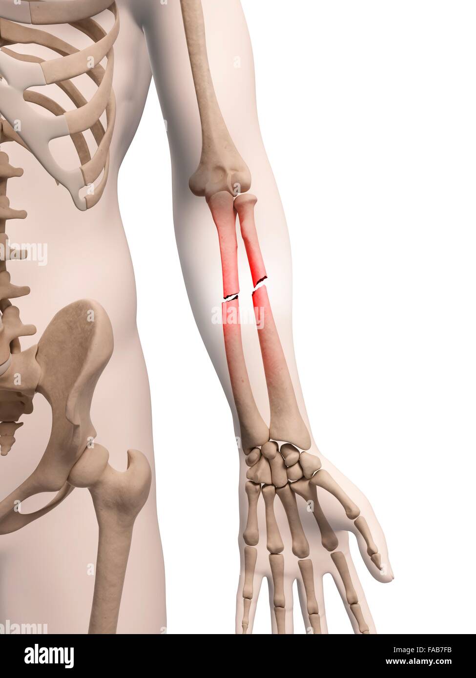 Les os du bras inférieur cassé, illustration de l'ordinateur. Banque D'Images