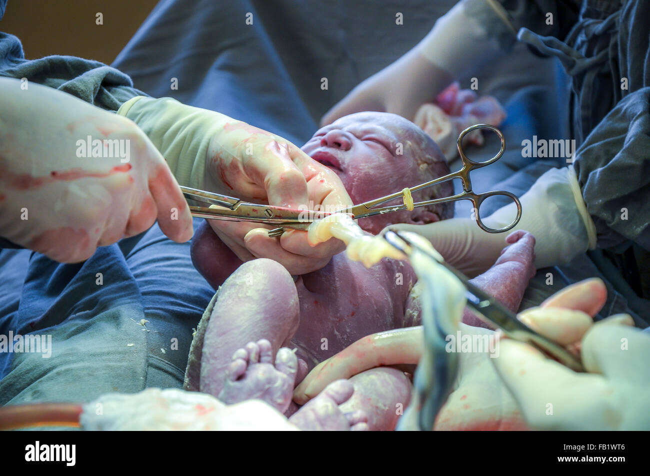 C section. L'équipe chirurgicale l'exécution de l'opération de chirurgie en maternité. Banque D'Images