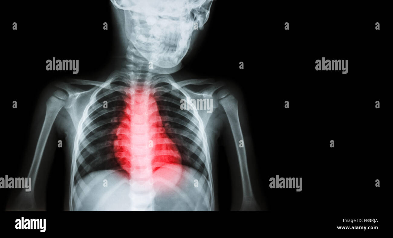 La maladie cardiaque ischémique , Infarctus du myocarde ( MI ) ( Film x-ray de corps humain avec la maladie cardiaque et la zone vide du côté droit Banque D'Images