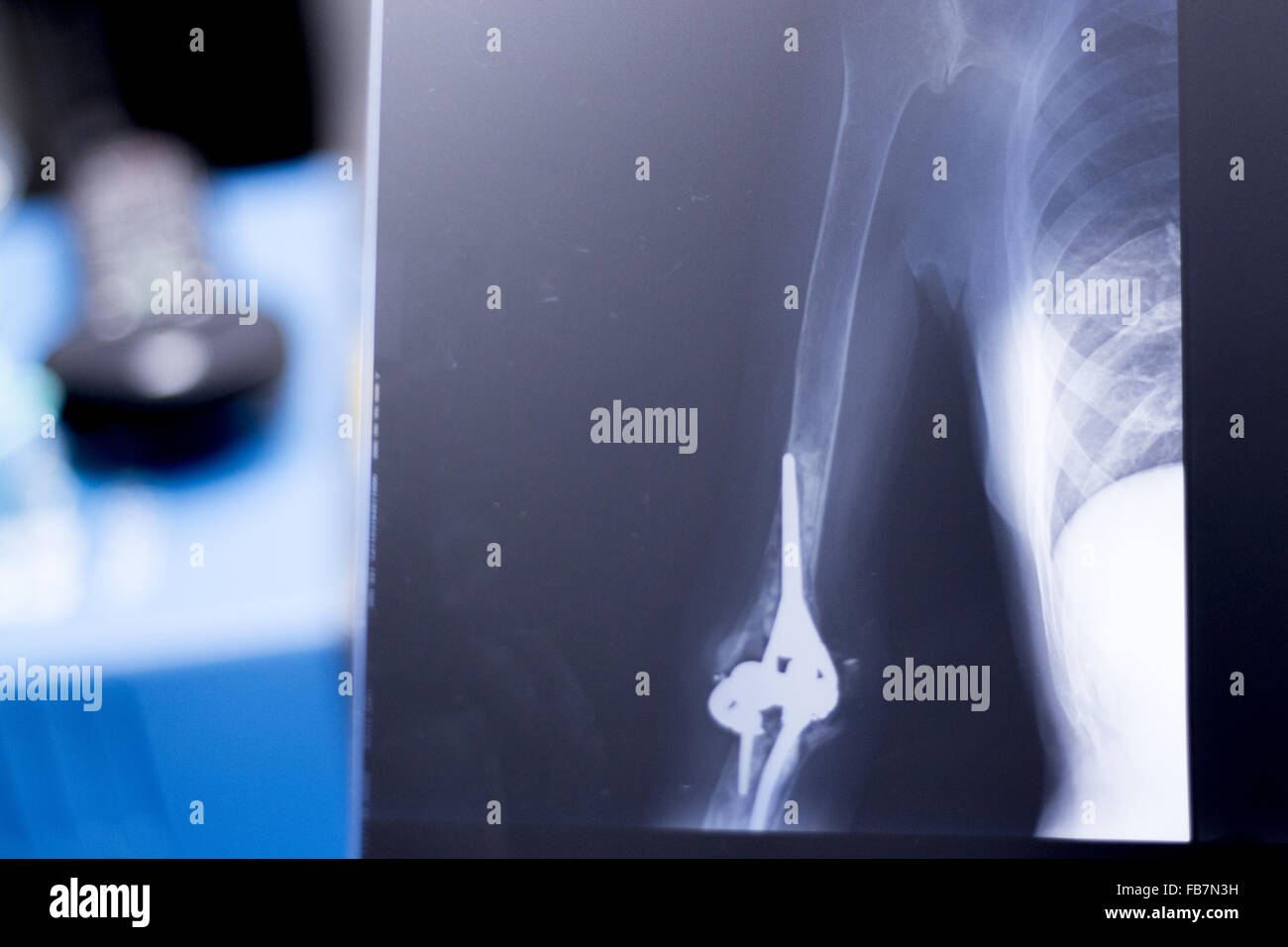 Othopedics et traumatologie implant chirurgical et le coude du bras de xray test d'acquisition des résultats montrant la plaque de métal et des vis en titane. Banque D'Images